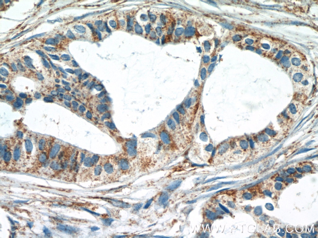 Immunohistochemistry (IHC) staining of human breast cancer tissue using SRPK1 Polyclonal antibody (14073-1-AP)