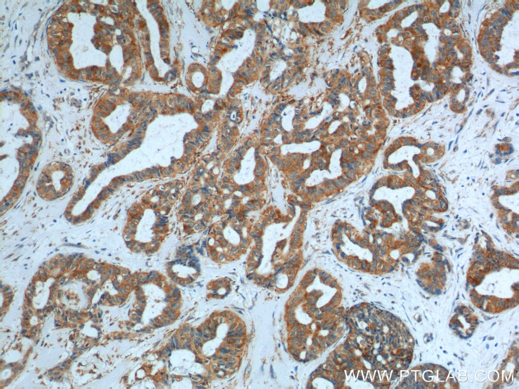 Immunohistochemistry (IHC) staining of human breast cancer tissue using SRPK1 Polyclonal antibody (14073-1-AP)