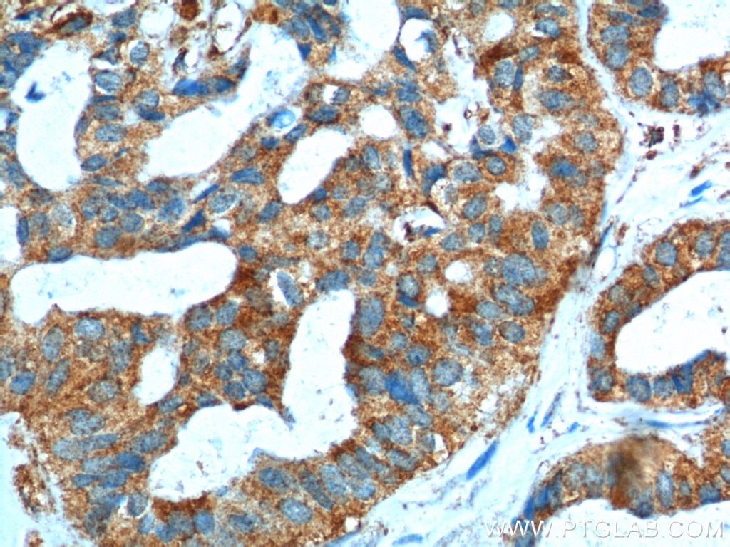 Immunohistochemistry (IHC) staining of human breast cancer tissue using SRPK1 Polyclonal antibody (14073-1-AP)
