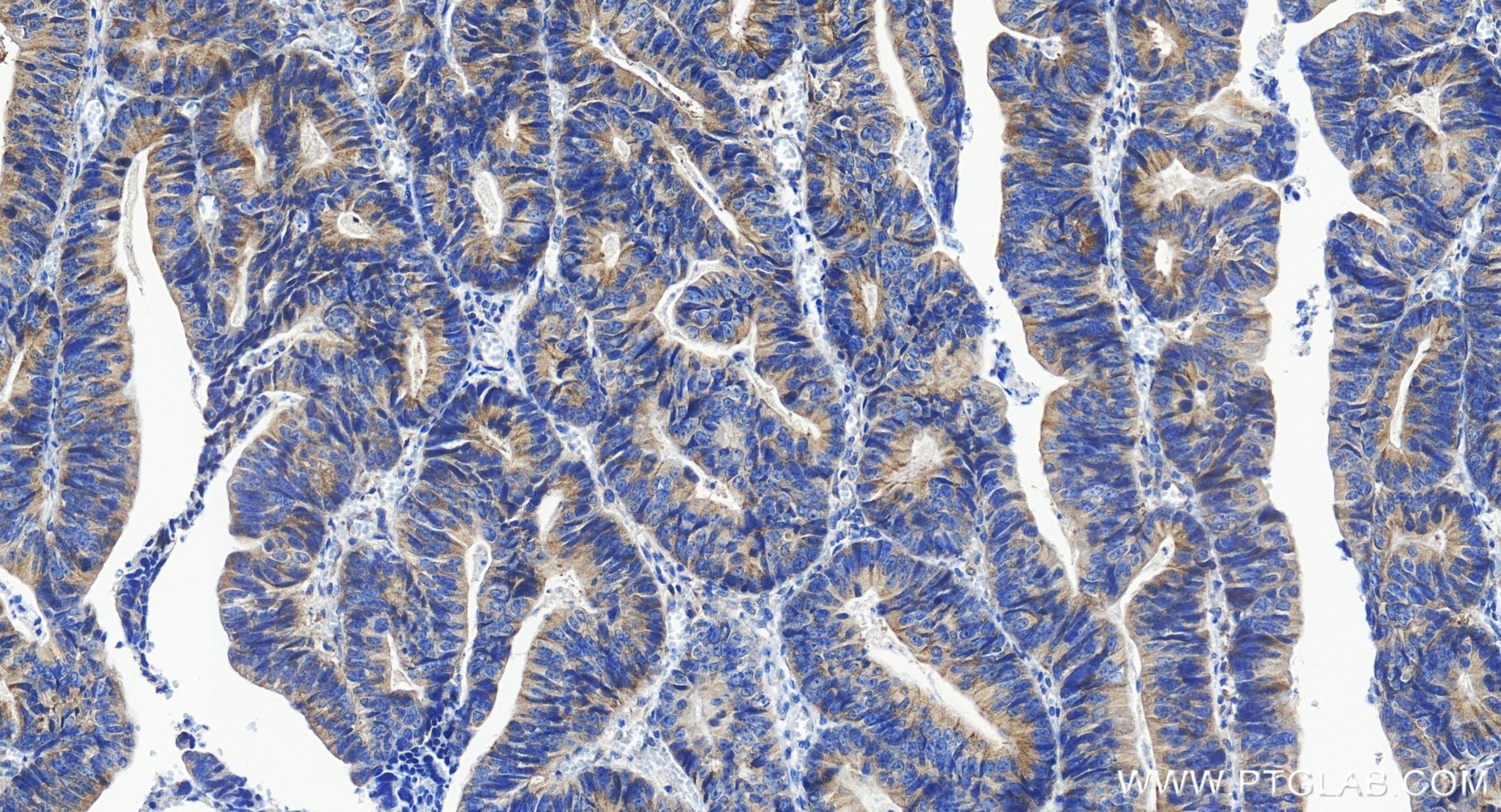 Immunohistochemistry (IHC) staining of human colon cancer tissue using SRPK2 Recombinant monoclonal antibody (85613-5-RR)