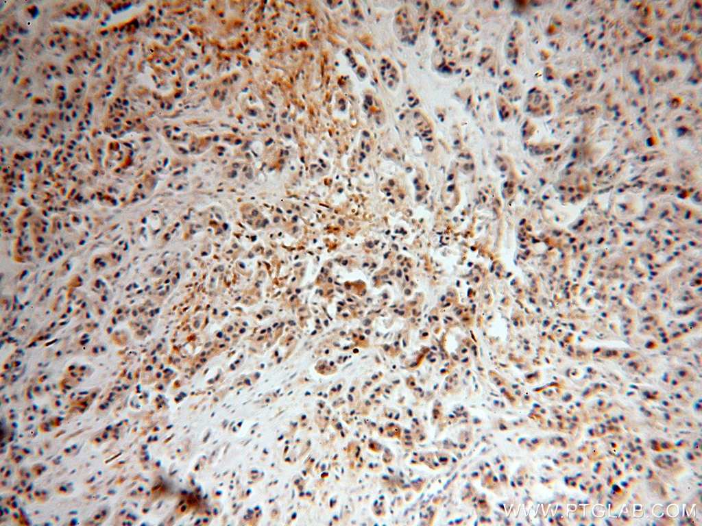IHC staining of human breast cancer using 12090-1-AP