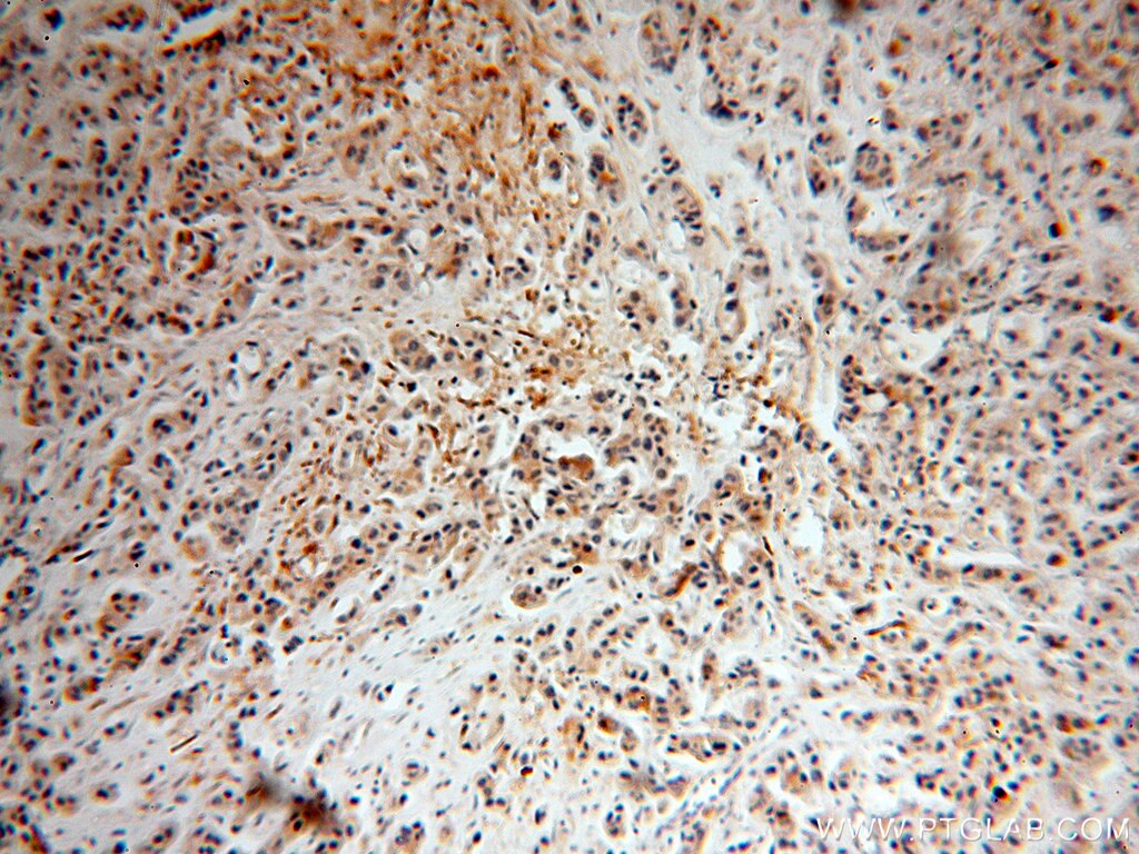 Immunohistochemistry (IHC) staining of human breast cancer tissue using SRPR Polyclonal antibody (12090-1-AP)