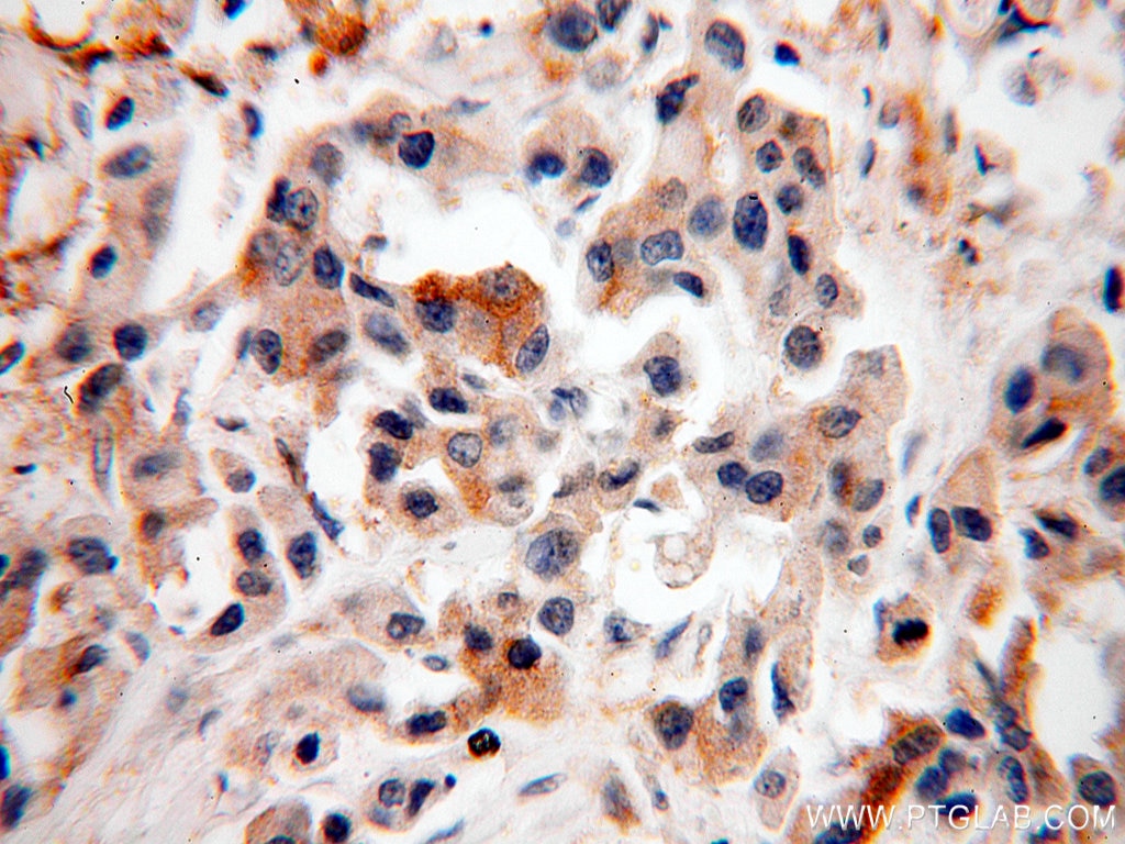 Immunohistochemistry (IHC) staining of human breast cancer tissue using SRPR Polyclonal antibody (12090-1-AP)