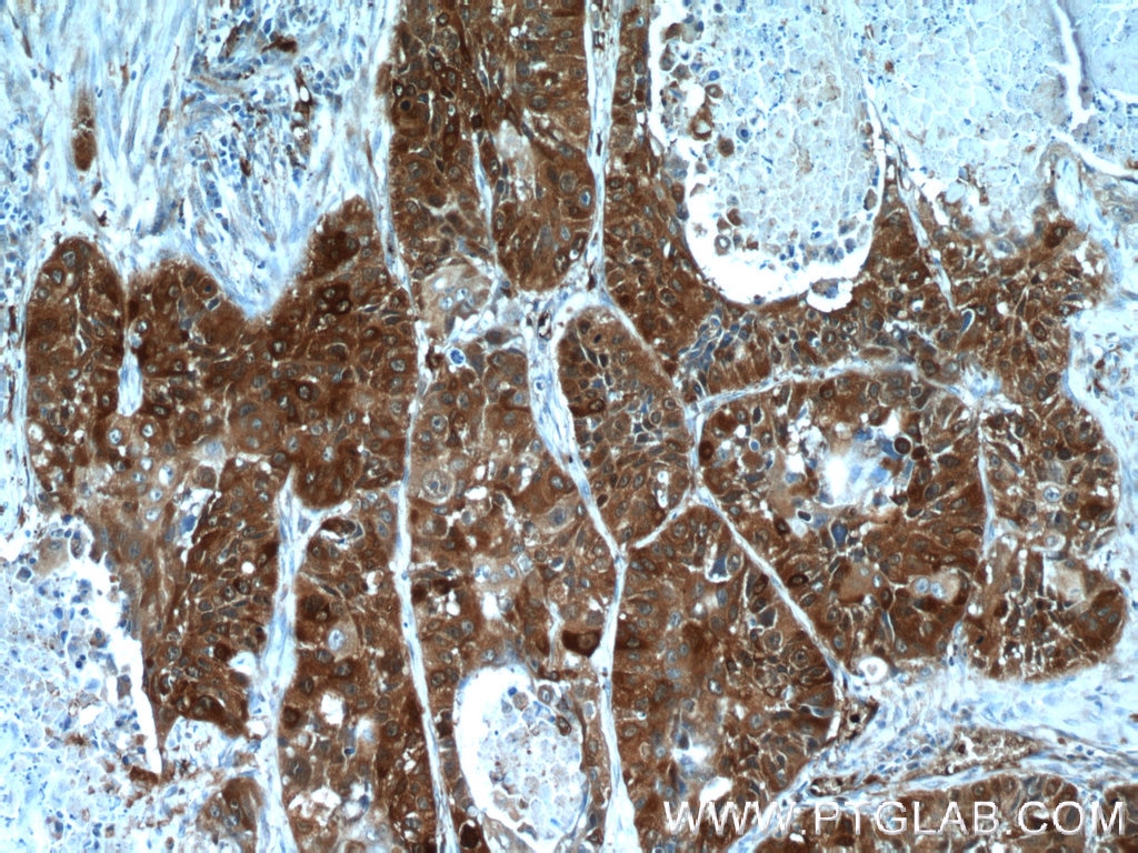 Immunohistochemistry (IHC) staining of human lung cancer tissue using SRX1 Polyclonal antibody (14273-1-AP)