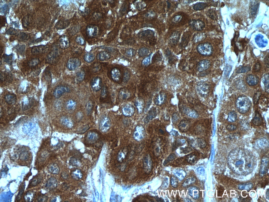 Immunohistochemistry (IHC) staining of human lung cancer tissue using SRX1 Polyclonal antibody (14273-1-AP)