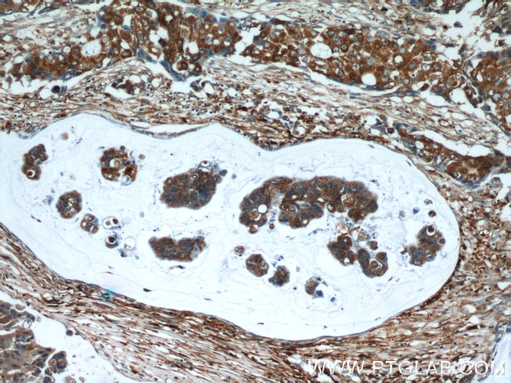 Immunohistochemistry (IHC) staining of human breast cancer tissue using SRX1 Polyclonal antibody (14273-1-AP)