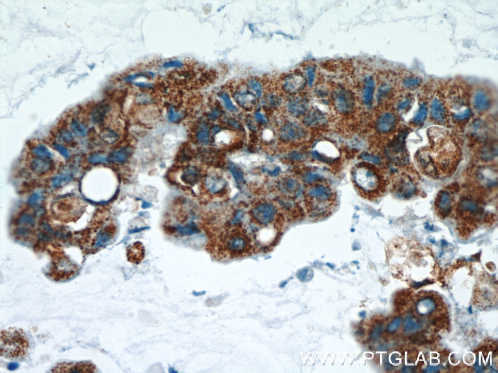 Immunohistochemistry (IHC) staining of human breast cancer tissue using SRX1 Polyclonal antibody (14273-1-AP)