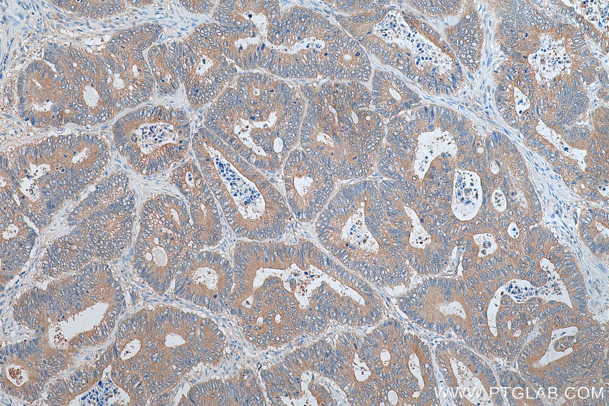 Immunohistochemistry (IHC) staining of human colon cancer tissue using SRX1 Polyclonal antibody (29849-1-AP)