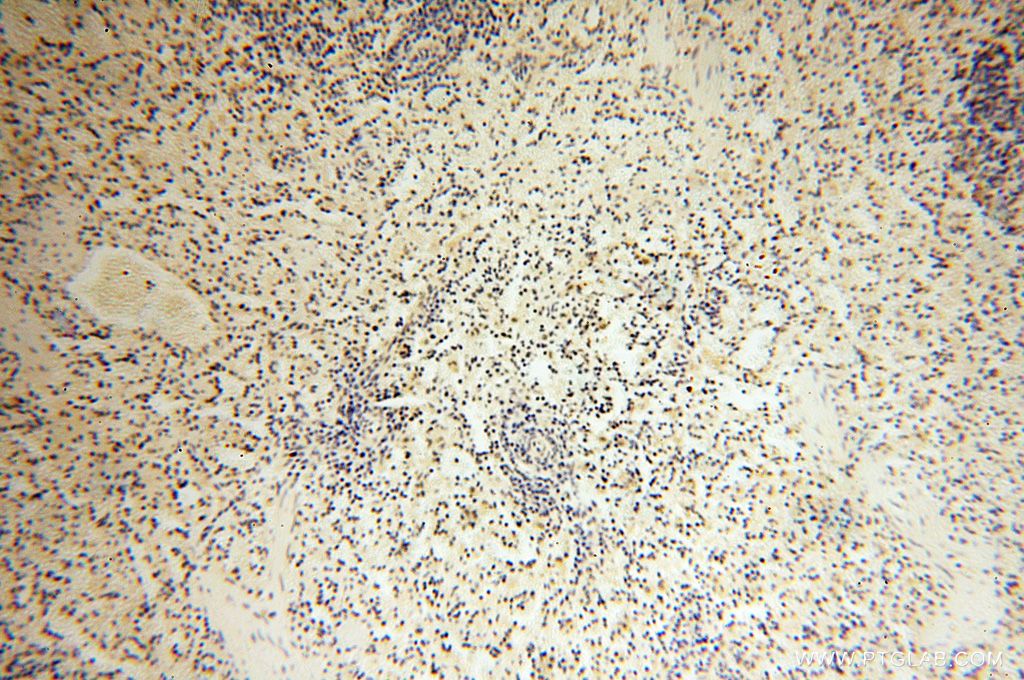 Immunohistochemistry (IHC) staining of human spleen tissue using SRY Polyclonal antibody (17930-1-AP)