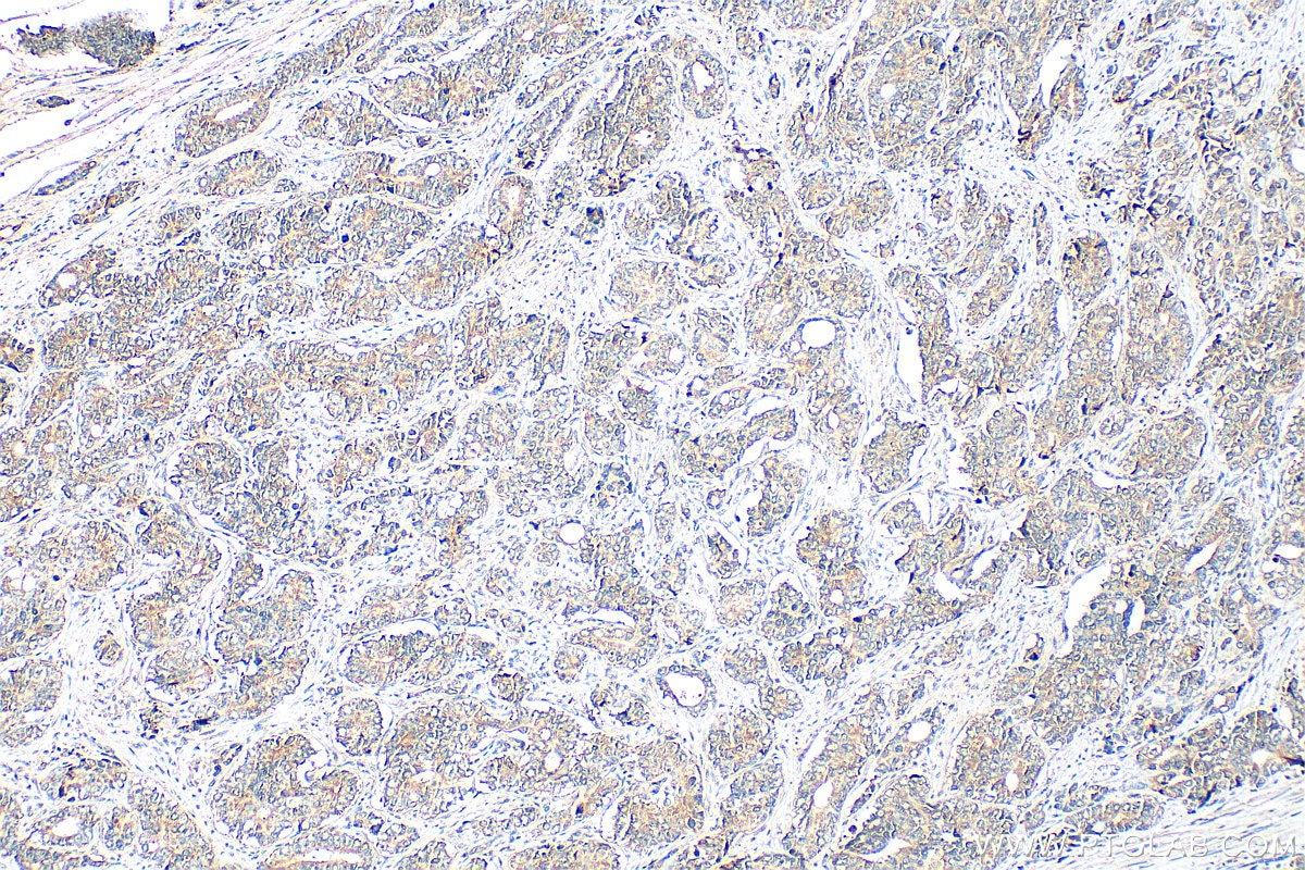 Immunohistochemistry (IHC) staining of human prostate cancer tissue using SS18L2 Polyclonal antibody (11817-1-AP)