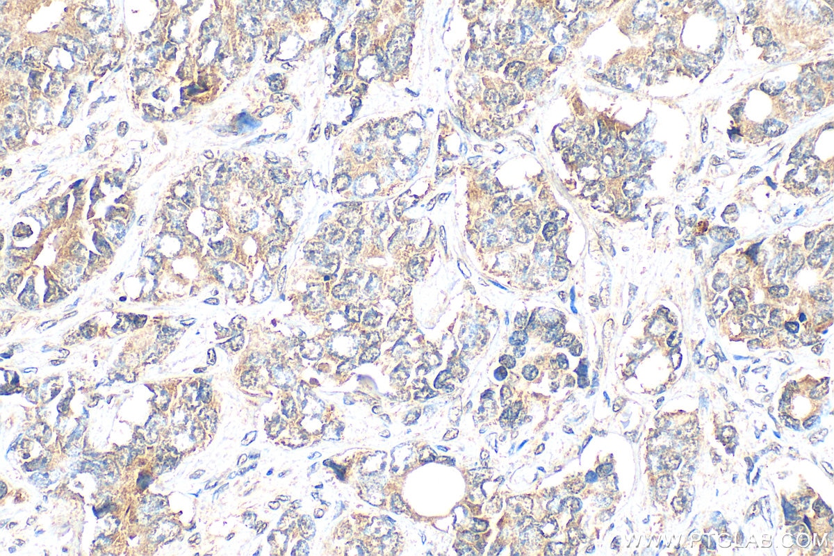 Immunohistochemistry (IHC) staining of human prostate cancer tissue using SS18L2 Polyclonal antibody (11817-1-AP)