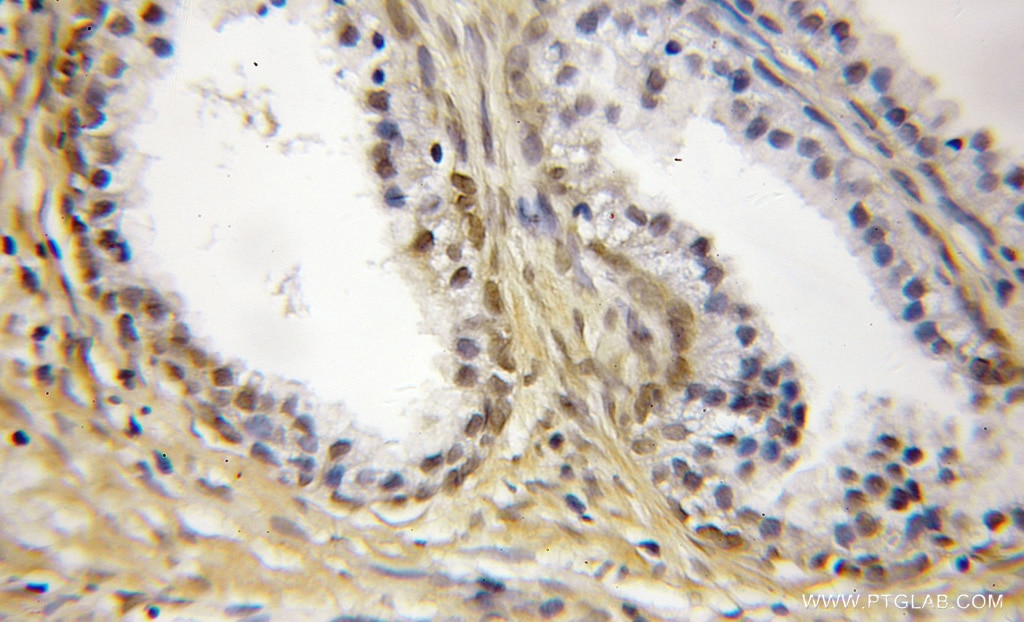 Immunohistochemistry (IHC) staining of human prostate cancer tissue using SS18L2 Polyclonal antibody (11817-1-AP)