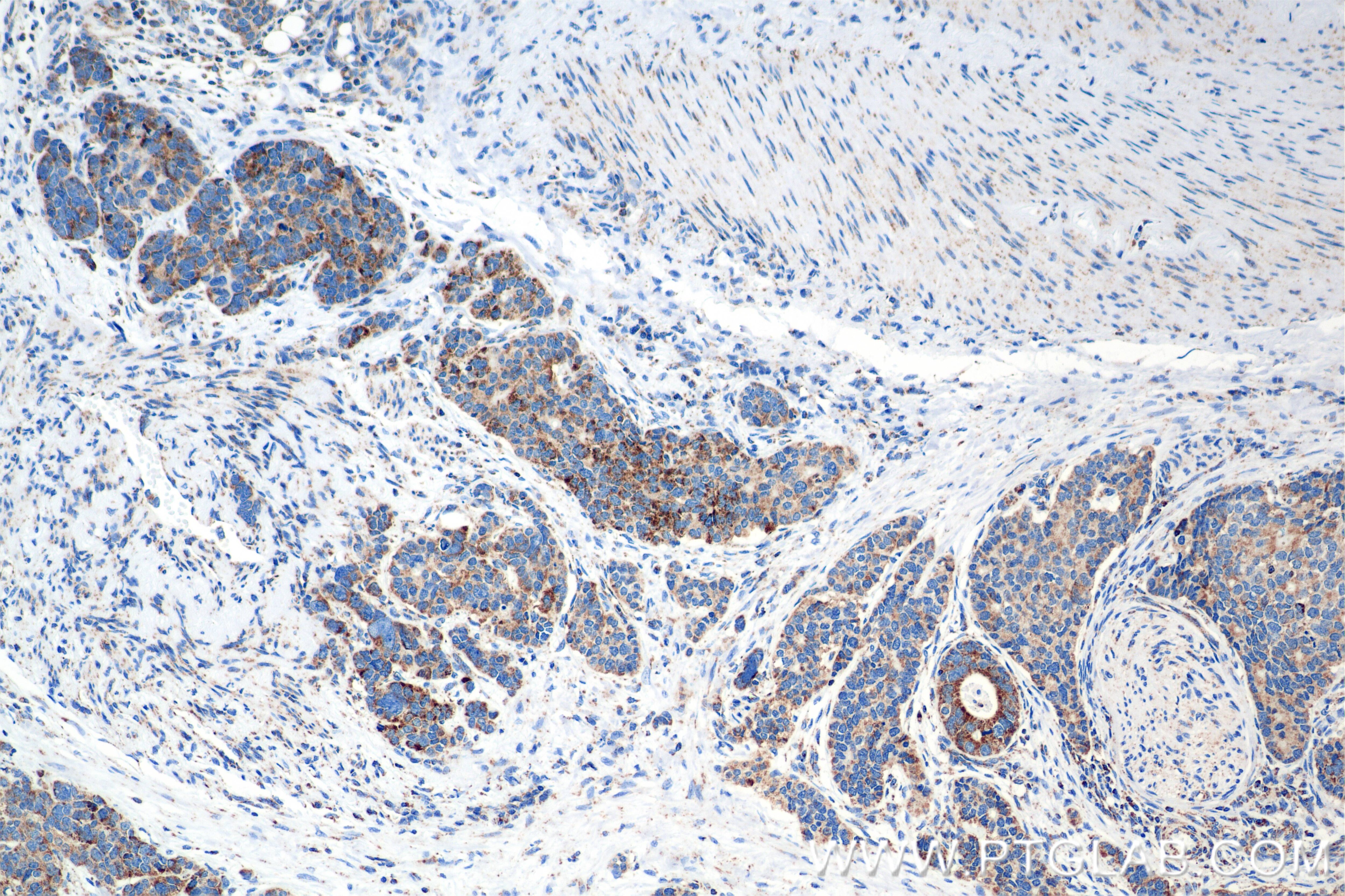 Immunohistochemistry (IHC) staining of human stomach cancer tissue using SSBP1 Recombinant antibody (84939-3-RR)