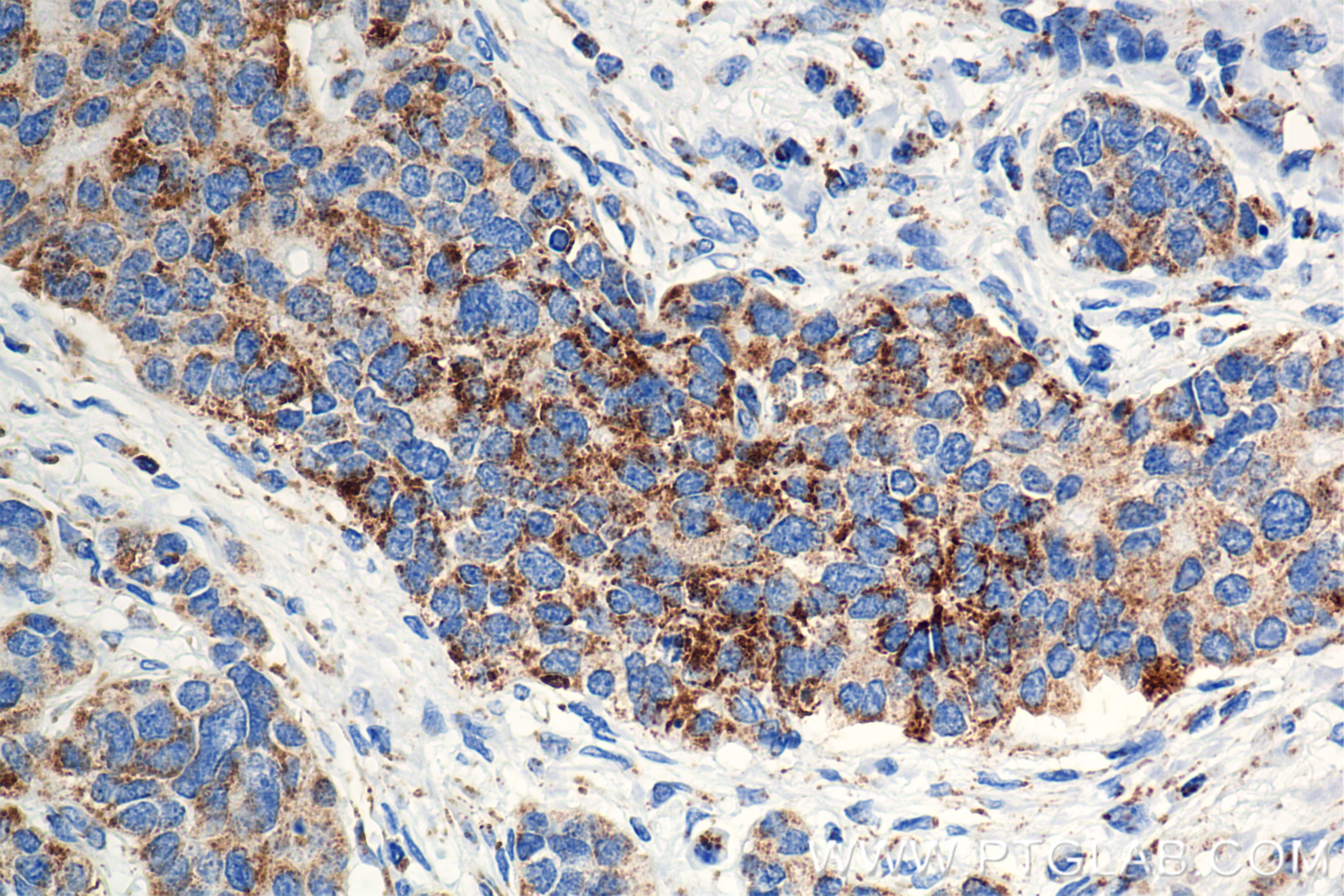 Immunohistochemistry (IHC) staining of human stomach cancer tissue using SSBP1 Recombinant antibody (84939-3-RR)