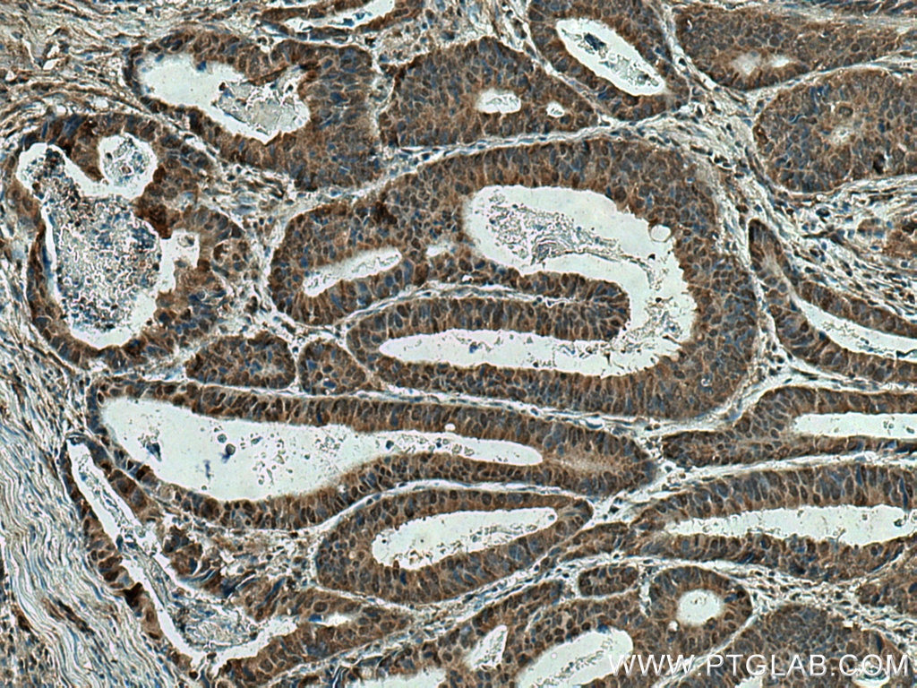 IHC staining of human colon cancer using 18324-1-AP