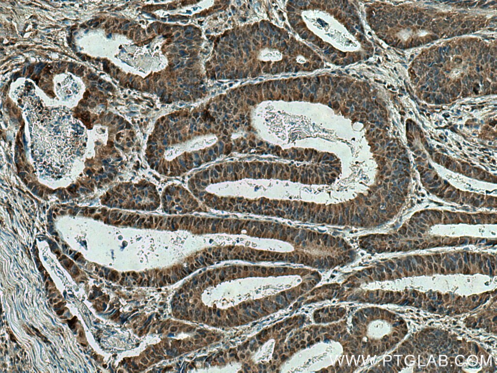 Immunohistochemistry (IHC) staining of human colon cancer tissue using SSH3 Polyclonal antibody (18324-1-AP)