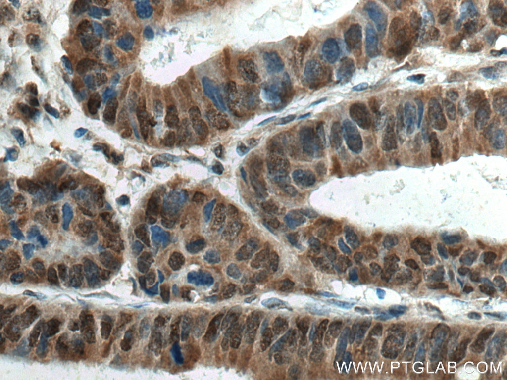 Immunohistochemistry (IHC) staining of human colon cancer tissue using SSH3 Polyclonal antibody (18324-1-AP)