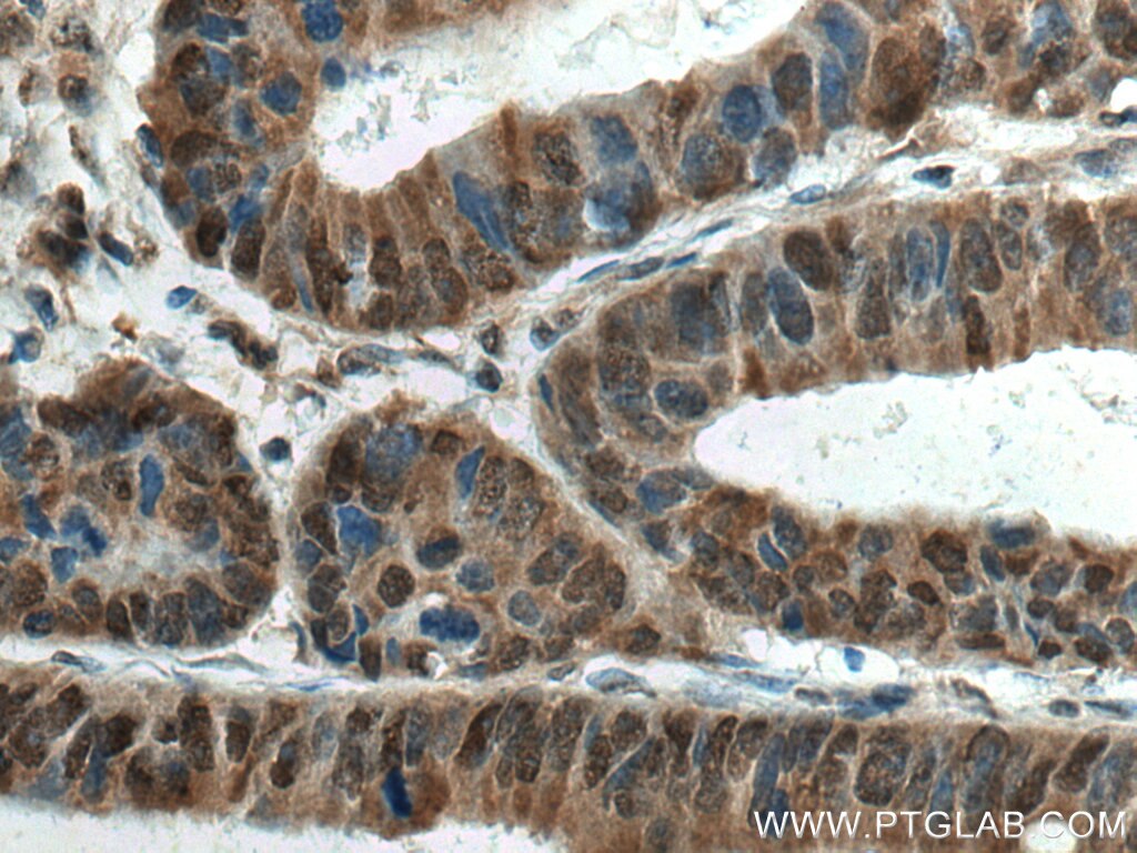 IHC staining of human colon cancer using 18324-1-AP