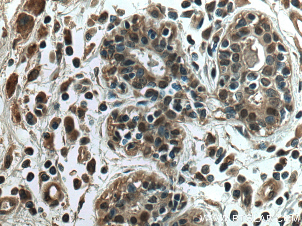 Immunohistochemistry (IHC) staining of human breast cancer tissue using SSH3 Polyclonal antibody (18324-1-AP)