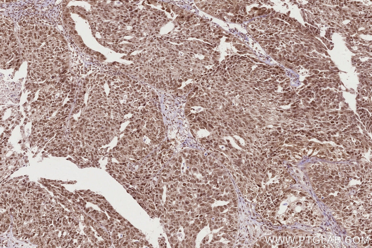 IHC staining of human ovary cancer using 68583-1-Ig Immunohistochemistry (IHC) staining of human ovary cancer tissue using SSH3 Monoclonal antibody (68583-1-Ig)