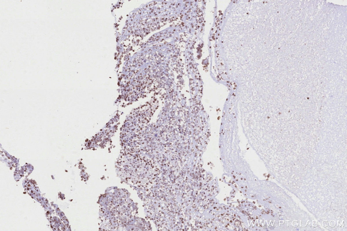 IHC staining of human ovary cancer using 68583-1-Ig Immunohistochemistry (IHC) staining of human ovary cancer tissue using SSH3 Monoclonal antibody (68583-1-Ig)