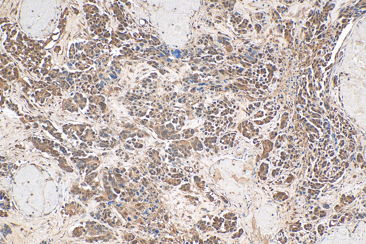 Immunohistochemistry (IHC) staining of human colon cancer tissue using NA14 Polyclonal antibody (11797-1-AP)