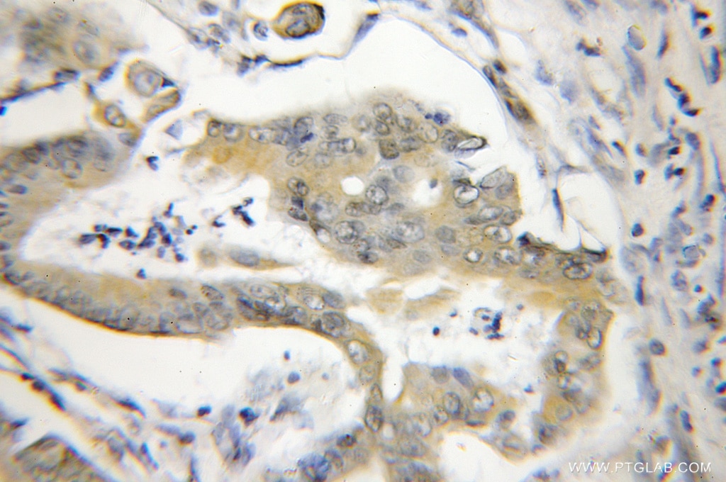 Immunohistochemistry (IHC) staining of human colon cancer tissue using NA14 Polyclonal antibody (11797-1-AP)