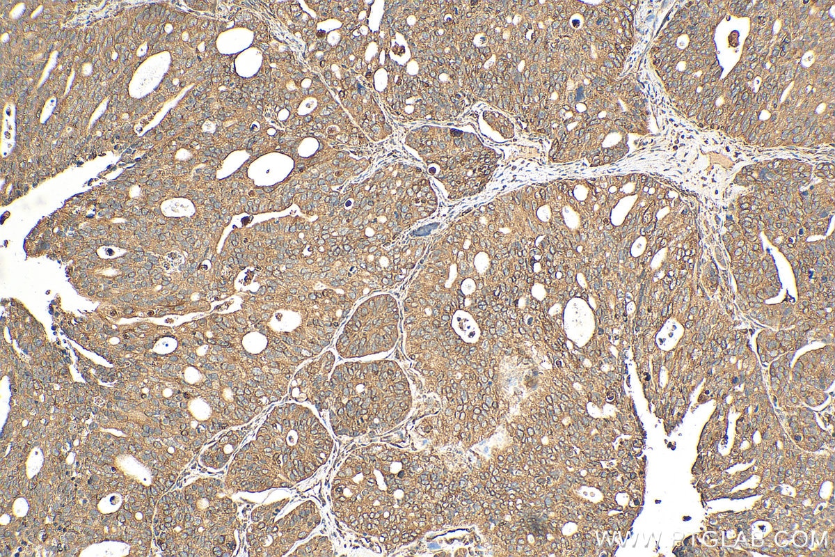 Immunohistochemistry (IHC) staining of human ovary tumor tissue using TRAPA/SSR1 Polyclonal antibody (10583-1-AP)