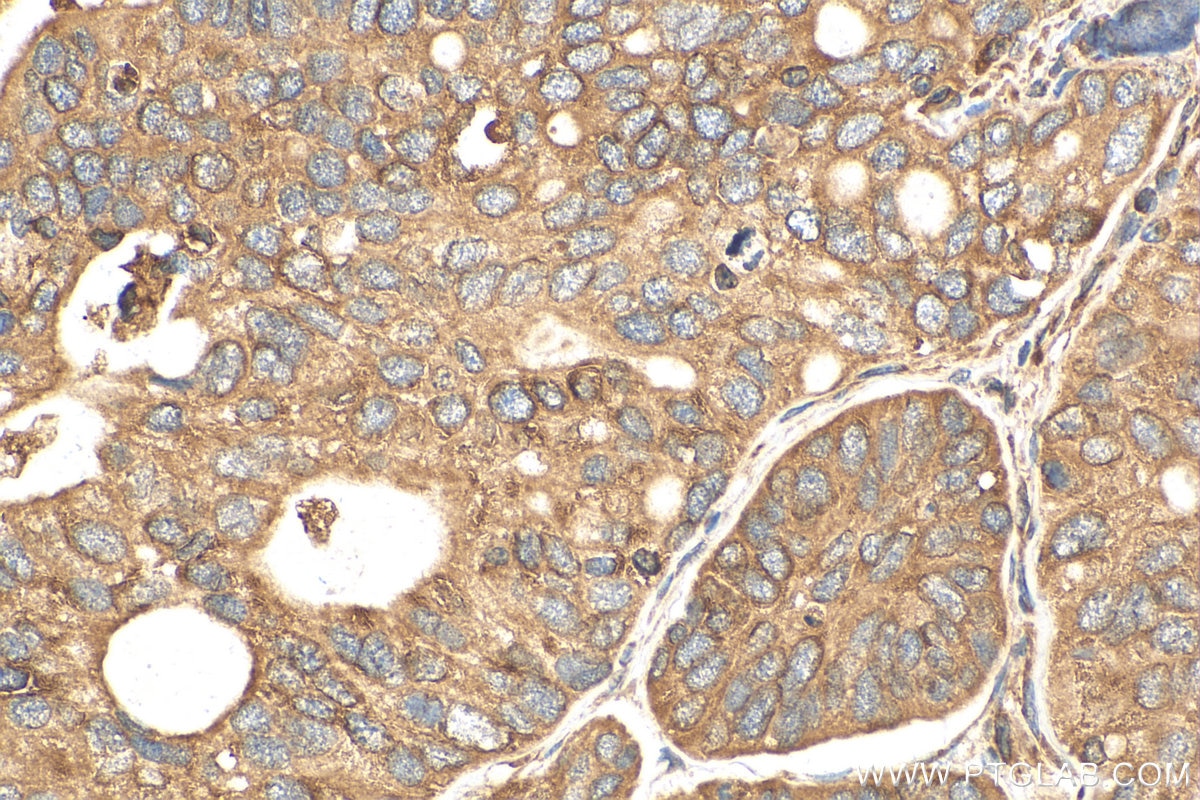 Immunohistochemistry (IHC) staining of human ovary tumor tissue using TRAPA/SSR1 Polyclonal antibody (10583-1-AP)