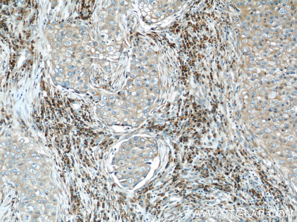 Immunohistochemistry (IHC) staining of human breast cancer tissue using TRAPB/SSR2 Polyclonal antibody (10278-1-AP)