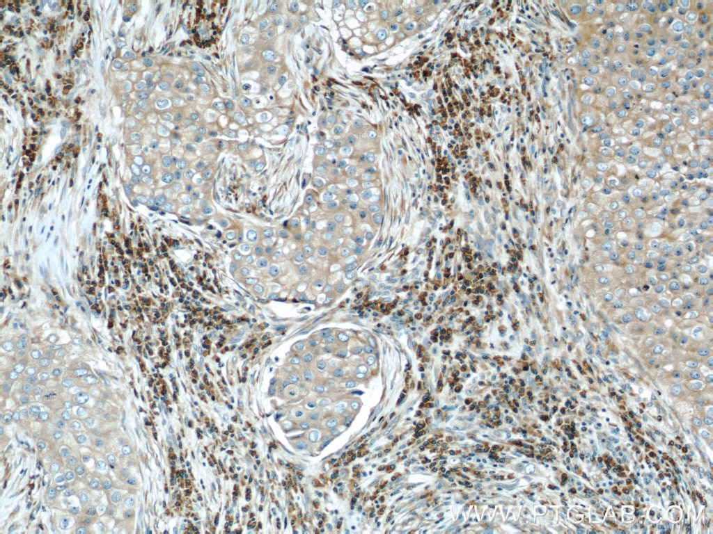 IHC staining of human breast cancer using 10278-1-AP