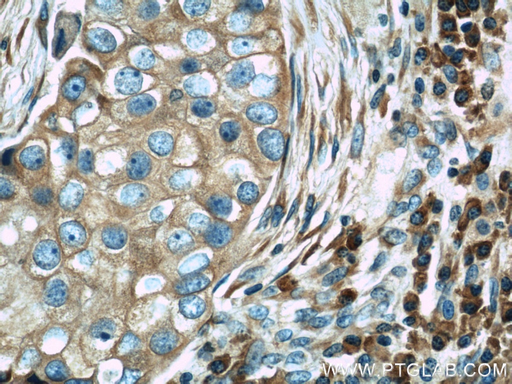 IHC staining of human breast cancer using 10278-1-AP