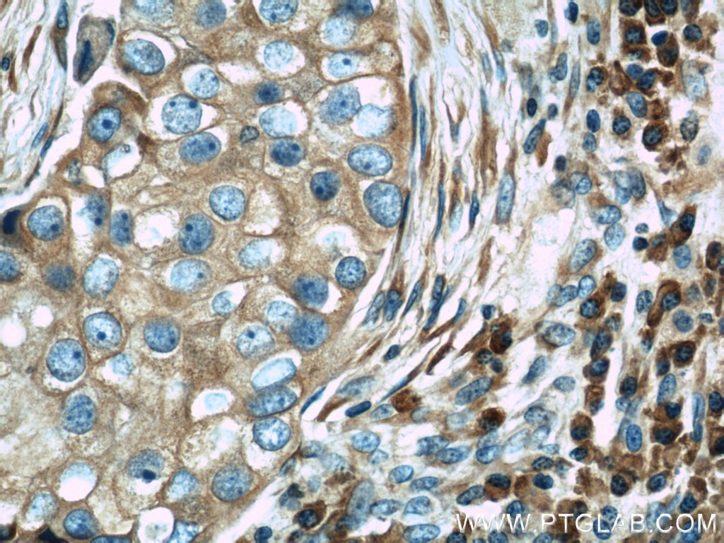 Immunohistochemistry (IHC) staining of human breast cancer tissue using TRAPB/SSR2 Polyclonal antibody (10278-1-AP)