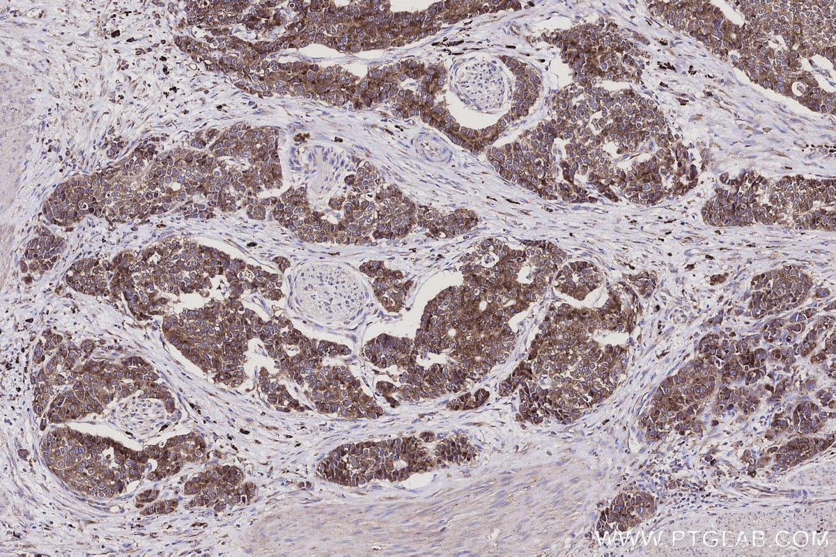 IHC staining of human stomach cancer using 30851-1-AP Immunohistochemistry (IHC) staining of human stomach cancer tissue using SSR3 Polyclonal antibody (30851-1-AP)