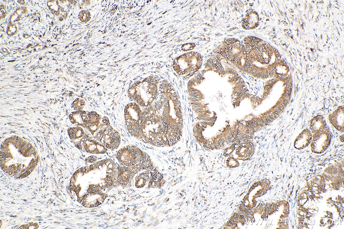 Immunohistochemistry (IHC) staining of human pancreas cancer tissue using SSR4 Polyclonal antibody (11655-2-AP)