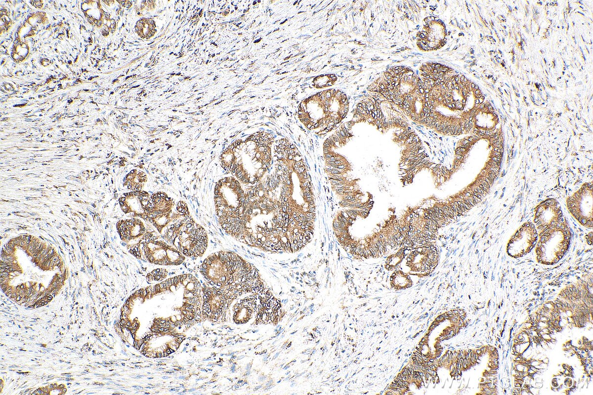 Immunohistochemistry (IHC) staining of human pancreas cancer tissue using SSR4 Polyclonal antibody (11655-2-AP)