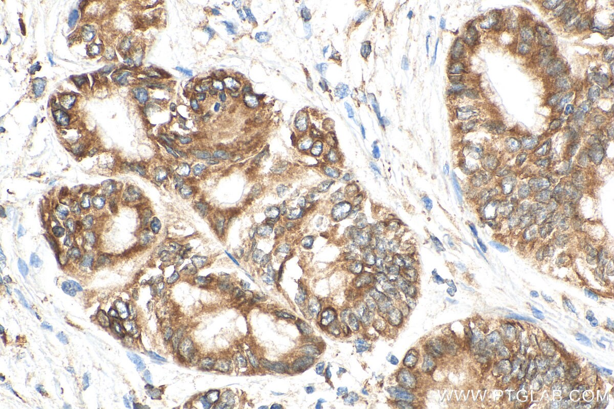 Immunohistochemistry (IHC) staining of human pancreas cancer tissue using SSR4 Polyclonal antibody (11655-2-AP)