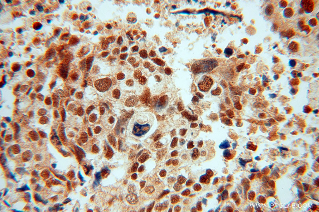 IHC staining of human ovary tumor using 15696-1-AP