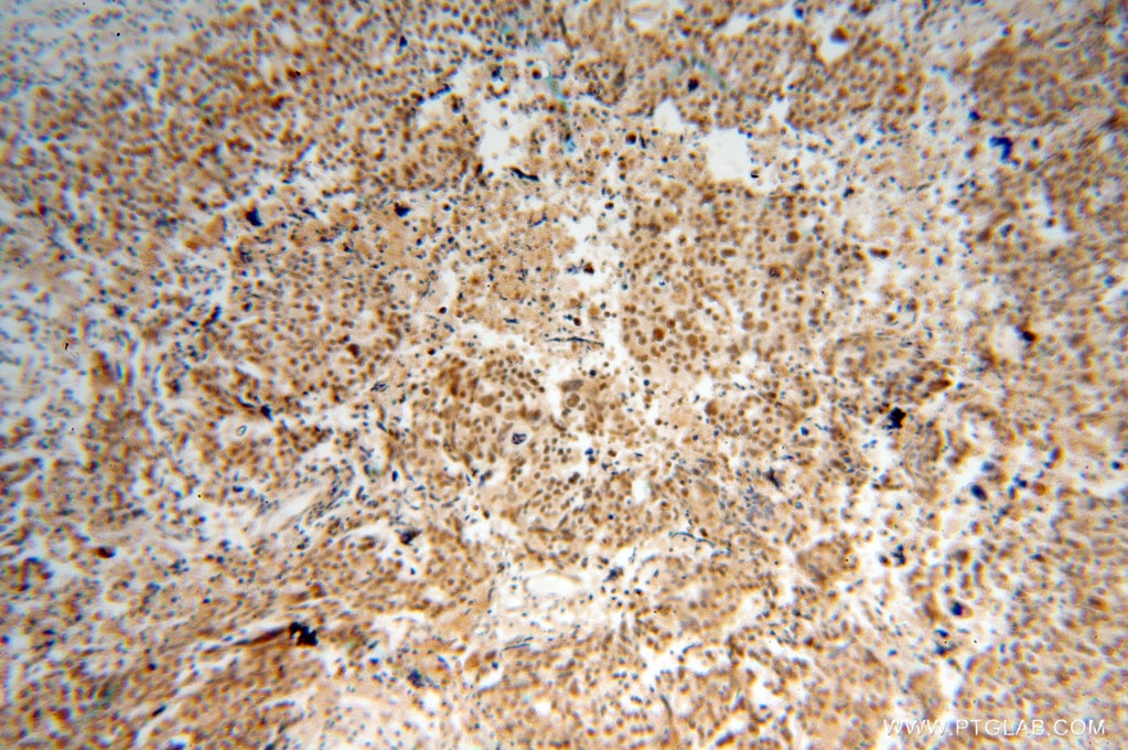 Immunohistochemistry (IHC) staining of human ovary tumor tissue using SSRP1 Polyclonal antibody (15696-1-AP)