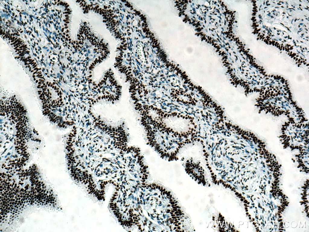 Immunohistochemistry (IHC) staining of human ovary tumor tissue using SSRP1 Monoclonal antibody (67313-1-Ig)