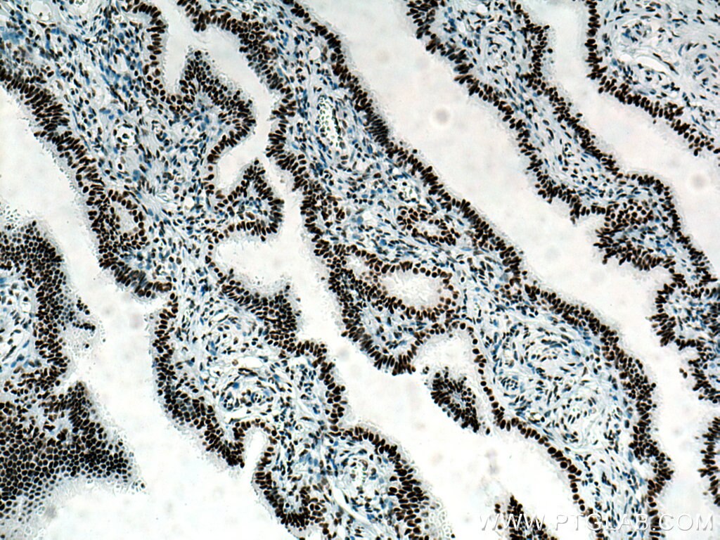 IHC staining of human ovary tumor using 67313-1-Ig