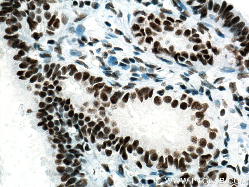 Immunohistochemistry (IHC) staining of human ovary tumor tissue using SSRP1 Monoclonal antibody (67313-1-Ig)