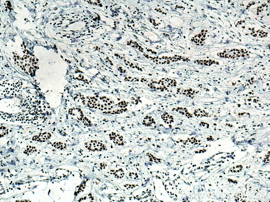 IHC staining of human breast cancer using 67313-1-Ig
