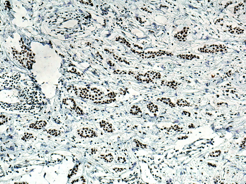 Immunohistochemistry (IHC) staining of human breast cancer tissue using SSRP1 Monoclonal antibody (67313-1-Ig)