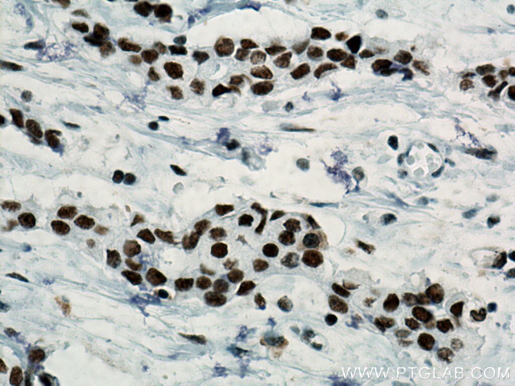 Immunohistochemistry (IHC) staining of human breast cancer tissue using SSRP1 Monoclonal antibody (67313-1-Ig)