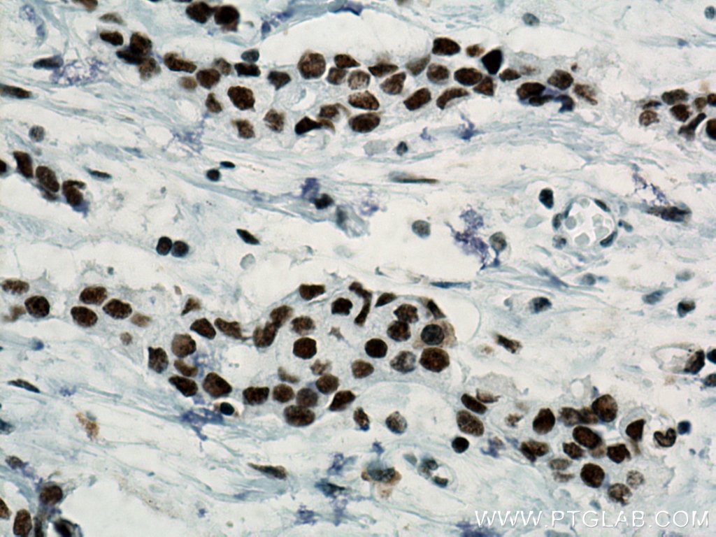 IHC staining of human breast cancer using 67313-1-Ig