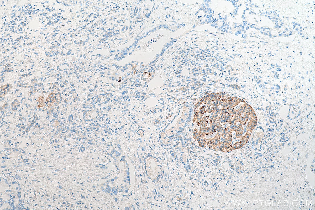 Immunohistochemistry (IHC) staining of human pancreas cancer tissue using Somatostatin (64-81aa) Polyclonal antibody (17512-1-AP)