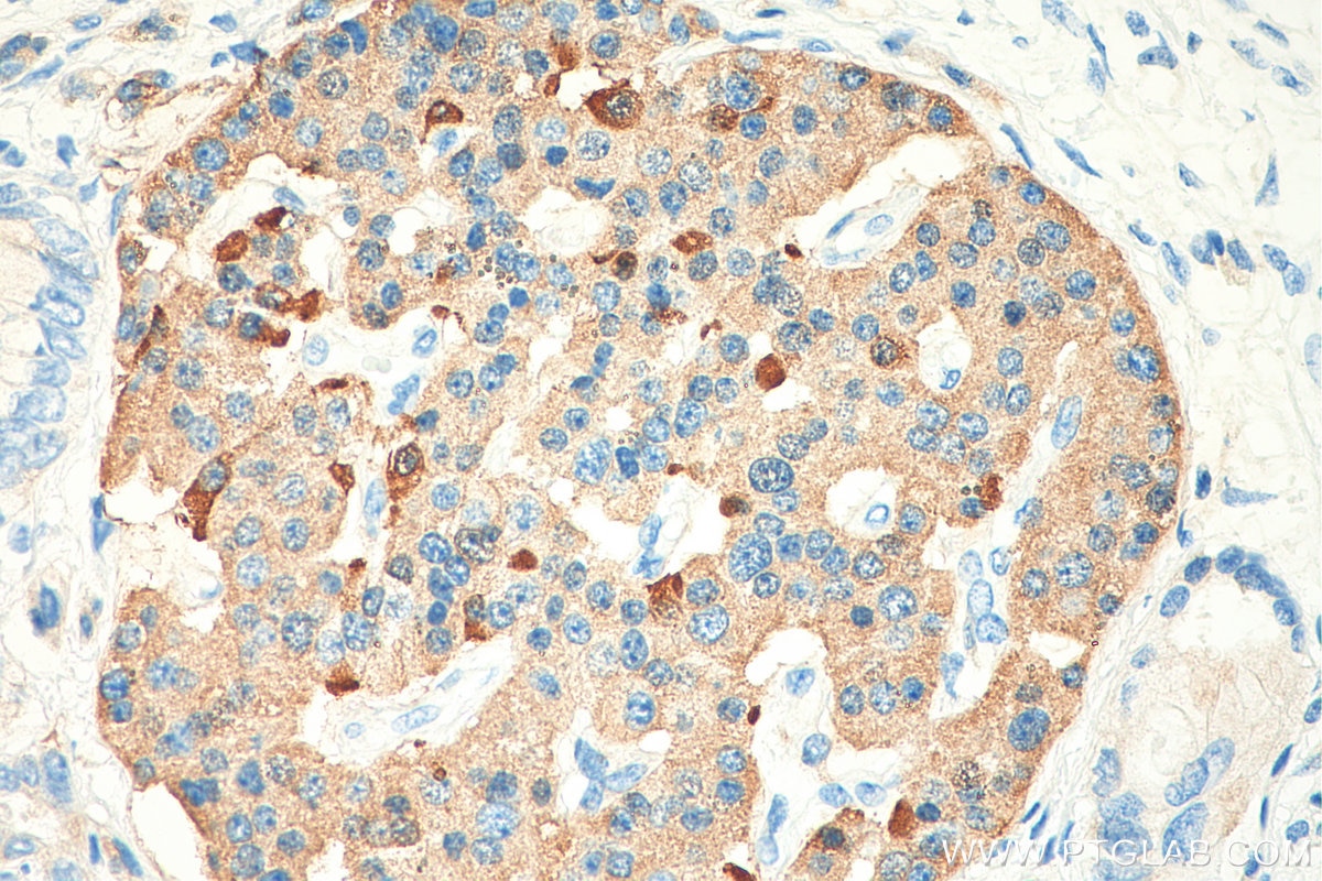 Immunohistochemistry (IHC) staining of human pancreas cancer tissue using Somatostatin (64-81aa) Polyclonal antibody (17512-1-AP)