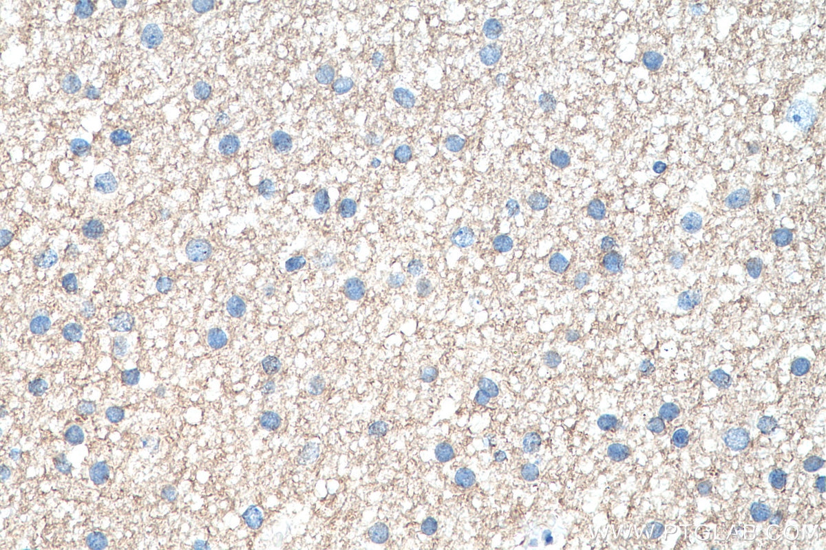 IHC staining of human gliomas using 20696-1-AP Immunohistochemistry (IHC) staining of human gliomas tissue using SSTR3 Polyclonal antibody (20696-1-AP)