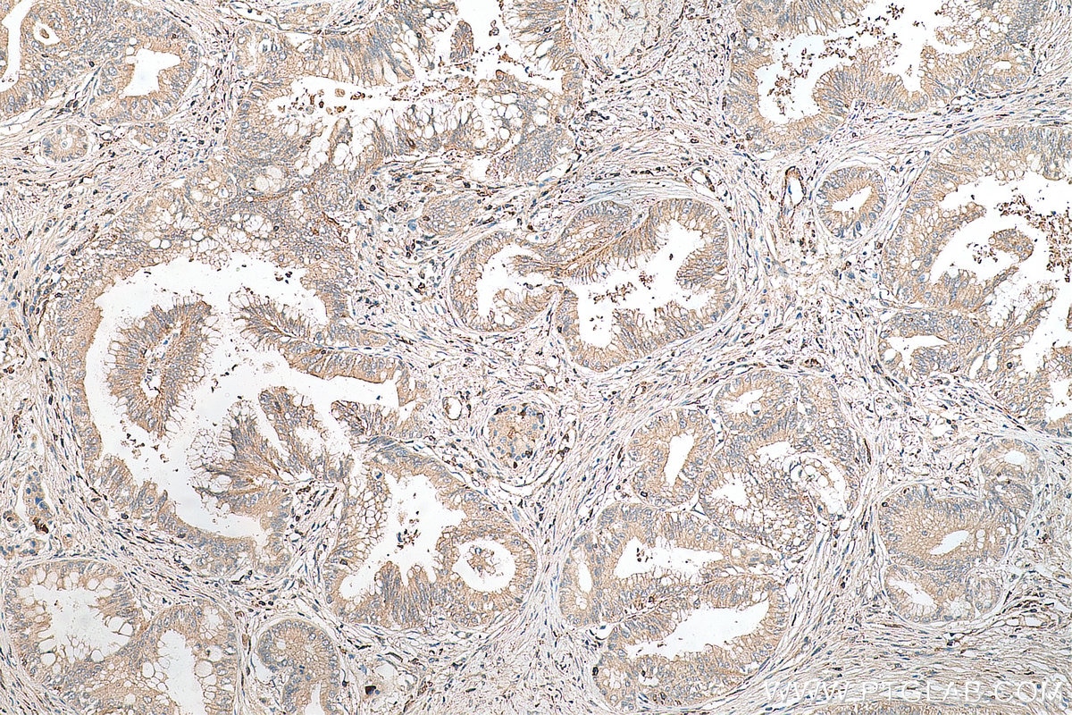 IHC staining of human pancreas cancer using 20696-1-AP Immunohistochemistry (IHC) staining of human pancreas cancer tissue using SSTR3 Polyclonal antibody (20696-1-AP)